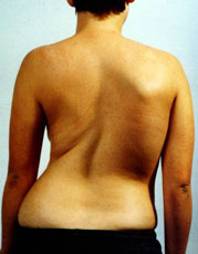 scoliosis_with_three_curves